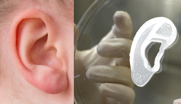 Ženi presađeno 3D printano uho od njenih stanica
